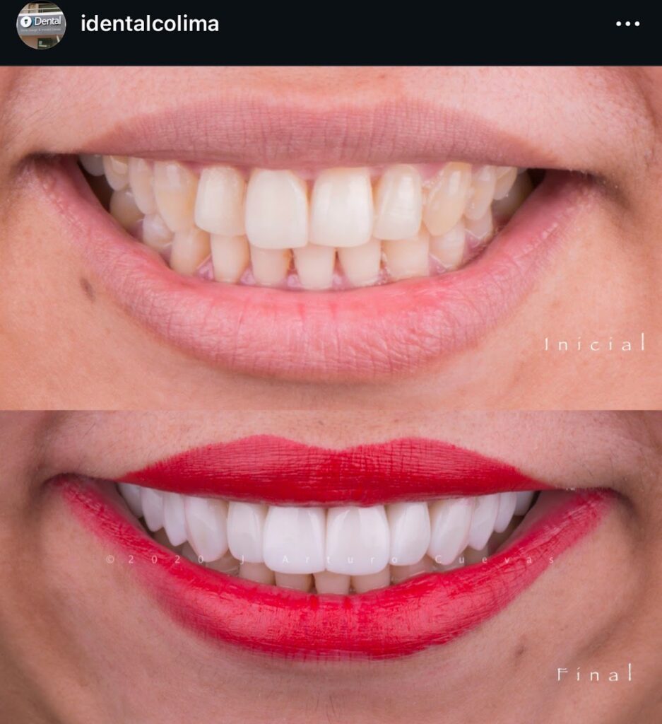 19794 dr. jorge arturo cuevas 8211 idental manzanillo 8211 diseno de sonrisa 8211 carillas dentales 8211 dentista 8211 implantes dentales 8211 937x1024