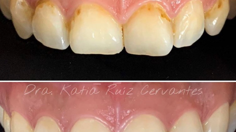 19907 implantes dentales morelia cenit odontologia avanzada dentistas en morelia diseno de sonrisa 768x432